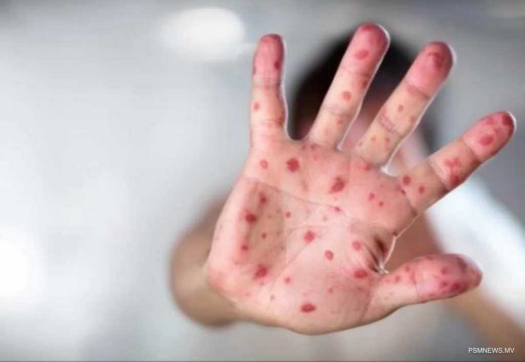 Maldives Records 121 Measles Cases as Health Authorities Intensify Vaccination Drive