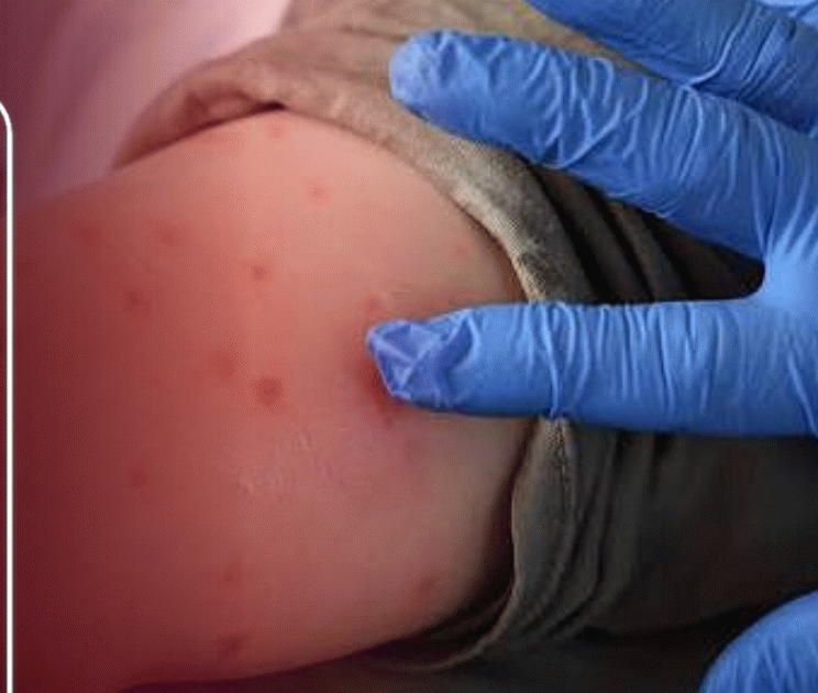 Measles cases fall sharply as only one new infection reported last week